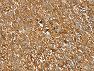 The image on the left is immunohistochemistry of paraffin-embedded Human gastric cancer tissue using TMPRSS11F Antibody(TMPRSS11F Antibody) at dilution 1/30, on the right is treated with synthetic peptide. (Original magnification: ×200)Rabbit anti-Human TMPRSS11F Polyclonal Antibody
