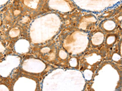 The image on the left is immunohistochemistry of paraffin-embedded Human thyroid cancer tissue using the antibody Antibody) at dilution 1/30, on the right is treated with synthetic peptide. (Original magnification: ×200)Rabbit anti-Human TMPRSS11F Polyclonal Antibody