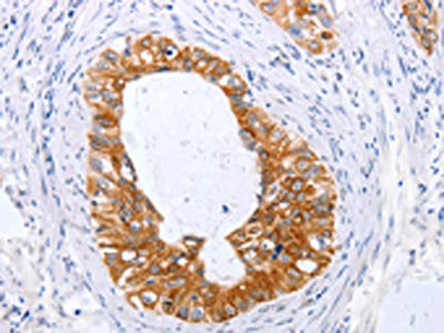 The image on the left is immunohistochemistry of paraffin-embedded Human cervical cancer tissue using TNFAIP1 Antibody(TNFAIP1 Antibody) at dilution 1/25, on the right is treated with fusion protein. (Original magnification: ×200)Rabbit anti-Human TNFAIP1 Polyclonal Antibody