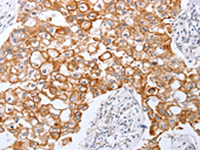 The image on the left is immunohistochemistry of paraffin-embedded Human breast cancer tissue using the antibody Antibody) at dilution 1/25, on the right is treated with fusion protein. (Original magnification: ×200)Rabbit anti-Human TNFAIP1 Polyclonal Antibody