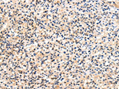 The image on the left is immunohistochemistry of paraffin-embedded Human prostate cancer tissue using USP47 Antibody(USP47 Antibody) at dilution 1/20, on the right is treated with fusion protein. (Original magnification: ×200)Rabbit anti-Human USP47 Polyclonal Antibody