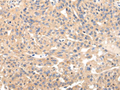 The image on the left is immunohistochemistry of paraffin-embedded Human breast cancer tissue using the antibody Antibody) at dilution 1/20, on the right is treated with fusion protein. (Original magnification: ×200)Rabbit anti-Human USP47 Polyclonal Antibody