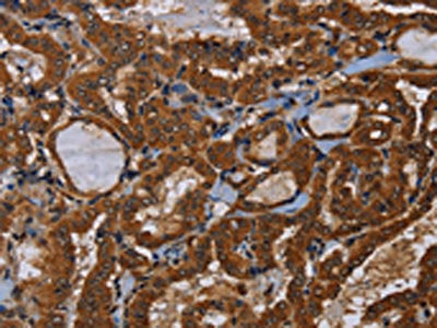 The image on the left is immunohistochemistry of paraffin-embedded Human thyroid cancer tissue using the antibody Antibody) at dilution 1/40, on the right is treated with fusion protein. (Original magnification: ×200)