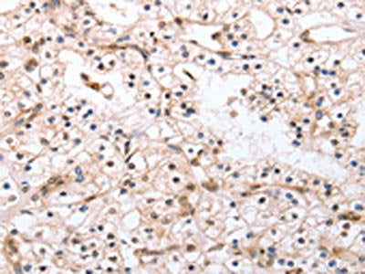 The image on the left is immunohistochemistry of paraffin-embedded Human renal cancer tissue using PDCD10 Antibody(PDCD10 Antibody) at dilution 1/20, on the right is treated with fusion protein. (Original magnification: ×200)