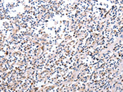 The image on the left is immunohistochemistry of paraffin-embedded Human tonsil tissue using the antibody Antibody) at dilution 1/20, on the right is treated with fusion protein. (Original magnification: ×200)