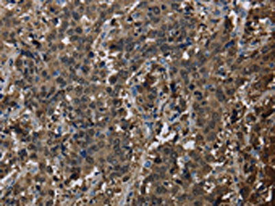 The image on the left is immunohistochemistry of paraffin-embedded Human liver cancer tissue using GSTA3 Antibody(GSTA3 Antibody) at dilution 1/30, on the right is treated with fusion protein. (Original magnification: ×200)Rabbit anti-Human GSTA3 Polyclonal Antibody