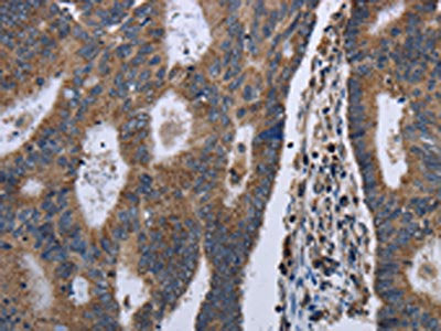The image on the left is immunohistochemistry of paraffin-embedded Human colon cancer tissue using the antibody Antibody) at dilution 1/30, on the right is treated with fusion protein. (Original magnification: ×200)Rabbit anti-Human GSTA3 Polyclonal Antibody