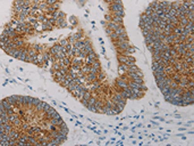 The image on the left is immunohistochemistry of paraffin-embedded Human colon cancer tissue using AIFM1 Antibody(AIFM1 Antibody) at dilution 1/15, on the right is treated with fusion protein. (Original magnification: ×200)Rabbit anti-Human AIFM1 Polyclonal Antibody