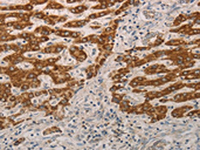 The image on the left is immunohistochemistry of paraffin-embedded Human liver cancer tissue using the antibody Antibody) at dilution 1/15, on the right is treated with fusion protein. (Original magnification: ×200)Rabbit anti-Human AIFM1 Polyclonal Antibody