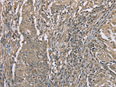 The image on the left is immunohistochemistry of paraffin-embedded Human cervical cancer tissue using SASH1 Antibody(SASH1 Antibody) at dilution 1/40, on the right is treated with synthetic peptide. (Original magnification: ×200)Rabbit anti-Human SASH1 Polyclonal Antibody