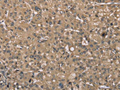 The image on the left is immunohistochemistry of paraffin-embedded Human liver cancer tissue using the antibody Antibody) at dilution 1/40, on the right is treated with synthetic peptide. (Original magnification: ×200)Rabbit anti-Human SASH1 Polyclonal Antibody