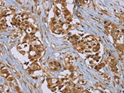 The image on the left is immunohistochemistry of paraffin-embedded Human breast cancer tissue using the antibody Antibody) at dilution 1/45, on the right is treated with synthetic peptide. (Original magnification: ×200)Rabbit anti-Human PUS10 Polyclonal Antibody