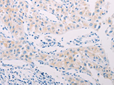 The image on the left is immunohistochemistry of paraffin-embedded Human lung cancer tissue using ADAMTS17 Antibody(ADAMTS17 Antibody) at dilution 1/60, on the right is treated with synthetic peptide. (Original magnification: ×200)Rabbit anti-Human ADAMTS17 Polyclonal Antibody