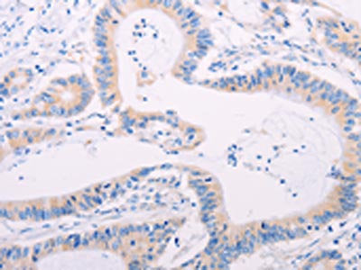 The image on the left is immunohistochemistry of paraffin-embedded Human colon cancer tissue using the antibody Antibody) at dilution 1/60, on the right is treated with synthetic peptide. (Original magnification: ×200)
