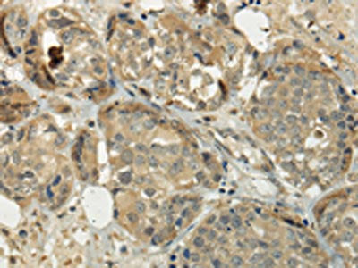 The image on the left is immunohistochemistry of paraffin-embedded Human breast cancer tissue using SIAH1 Antibody(SIAH1 Antibody) at dilution 1/35, on the right is treated with fusion protein. (Original magnification: ×200)Rabbit anti-Human SIAH1 Polyclonal Antibody