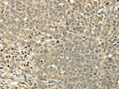 The image on the left is immunohistochemistry of paraffin-embedded Human ovarian cancer tissue using the antibody Antibody) at dilution 1/35, on the right is treated with fusion protein. (Original magnification: ×200)Rabbit anti-Human SIAH1 Polyclonal Antibody