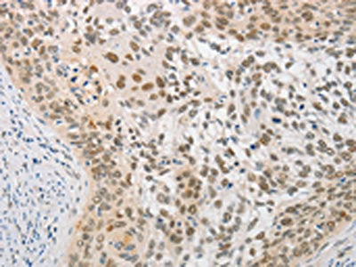 The image on the left is immunohistochemistry of paraffin-embedded Human cervical cancer tissue using SAE1 Antibody(SAE1 Antibody) at dilution 1/20, on the right is treated with fusion protein. (Original magnification: ×200)Rabbit anti-Human SAE1 Polyclonal Antibody