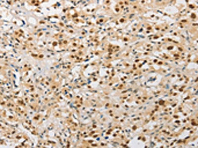 The image on the left is immunohistochemistry of paraffin-embedded Human thyroid cancer tissue using the antibody Antibody) at dilution 1/20, on the right is treated with fusion protein. (Original magnification: ×200)Rabbit anti-Human SAE1 Polyclonal Antibody