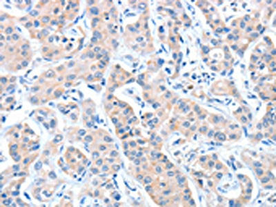 The image on the left is immunohistochemistry of paraffin-embedded Human lung cancer tissue using CASP7 Antibody(CASP7 Antibody) at dilution 1/20, on the right is treated with fusion protein. (Original magnification: X200)