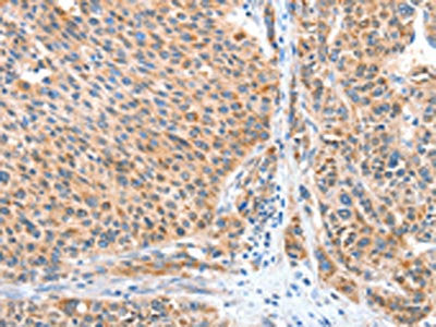 The image on the left is immunohistochemistry of paraffin-embedded Human liver cancer tissue using the antibody Antibody) at dilution 1/20, on the right is treated with fusion protein. (Original magnification: X200)