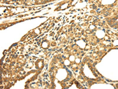 The image on the left is immunohistochemistry of paraffin-embedded Human thyroid cancer tissue using SRPRB Antibody(SRPRB Antibody) at dilution 1/30, on the right is treated with fusion protein. (Original magnification: ×200)Rabbit anti-Human SRPRB Polyclonal Antibody