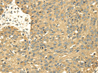 The image on the left is immunohistochemistry of paraffin-embedded Human breast cancer tissue using the antibody Antibody) at dilution 1/30, on the right is treated with fusion protein. (Original magnification: ×200)Rabbit anti-Human SRPRB Polyclonal Antibody