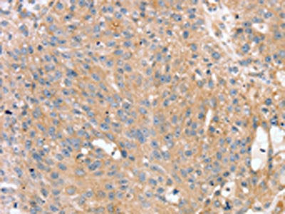 The image on the left is immunohistochemistry of paraffin-embedded Human breast cancer tissue using PTX3 Antibody(PTX3 Antibody) at dilution 1/40, on the right is treated with synthetic peptide. (Original magnification: ×200)Rabbit anti-Human PTX3 Polyclonal Antibody