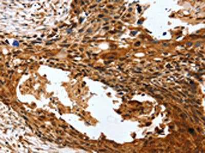 The image on the left is immunohistochemistry of paraffin-embedded Human esophagus cancer tissue using the antibody Antibody) at dilution 1/40, on the right is treated with synthetic peptide. (Original magnification: ×200)Rabbit anti-Human PTX3 Polyclonal Antibody