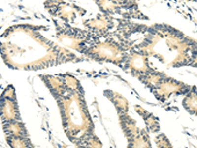 The image on the left is immunohistochemistry of paraffin-embedded Human colorectal cancer tissue using RASD2 Antibody(RASD2 Antibody) at dilution 1/20, on the right is treated with fusion protein. (Original magnification: ×200)Rabbit anti-Human RASD2 Polyclonal Antibody