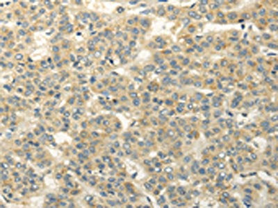 The image on the left is immunohistochemistry of paraffin-embedded Human liver cancer tissue using the antibody Antibody) at dilution 1/20, on the right is treated with fusion protein. (Original magnification: ×200)Rabbit anti-Human RASD2 Polyclonal Antibody