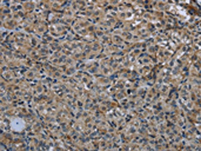 The image on the left is immunohistochemistry of paraffin-embedded Human thyroid cancer tissue using MAPKAPK2 Antibody(MAPKAPK2 Antibody) at dilution 1/20, on the right is treated with synthetic peptide. (Original magnification: ×200)