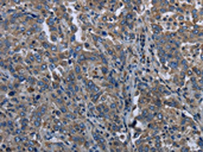 The image on the left is immunohistochemistry of paraffin-embedded Human liver cancer tissue using the antibody Antibody) at dilution 1/20, on the right is treated with synthetic peptide. (Original magnification: ×200)