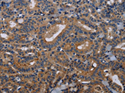 The image on the left is immunohistochemistry of paraffin-embedded Human thyroid cancer tissue using the antibody Antibody) at dilution 1/40, on the right is treated with fusion protein. (Original magnification: ×200)Rabbit anti-Human PVRL3 Polyclonal Antibody