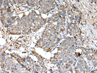 The image on the left is immunohistochemistry of paraffin-embedded Human breast cancer tissue using SLC1A1 Antibody(SLC1A1 Antibody) at dilution 1/30, on the right is treated with synthetic peptide. (Original magnification: ×200)Rabbit anti-Human SLC1A1 Polyclonal Antibody