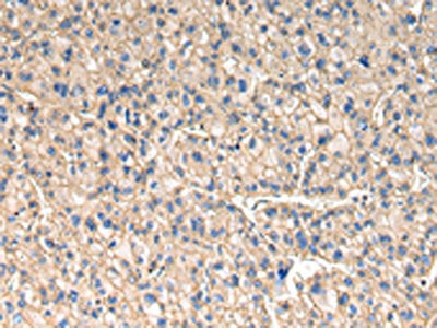 The image on the left is immunohistochemistry of paraffin-embedded Human liver cancer tissue using the antibody Antibody) at dilution 1/30, on the right is treated with synthetic peptide. (Original magnification: ×200)Rabbit anti-Human SLC1A1 Polyclonal Antibody