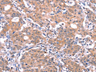 The image on the left is immunohistochemistry of paraffin-embedded Human gastric cancer tissue using GABRA1 Antibody(GABRA1 Antibody) at dilution 1/30, on the right is treated with synthetic peptide. (Original magnification: ×200)Rabbit anti-Human GABRA1 Polyclonal Antibody