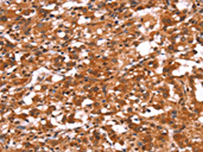 The image on the left is immunohistochemistry of paraffin-embedded Human thyroid cancer tissue using the antibody Antibody) at dilution 1/30, on the right is treated with synthetic peptide. (Original magnification: ×200)Rabbit anti-Human GABRA1 Polyclonal Antibody