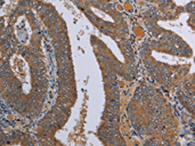 The image on the left is immunohistochemistry of paraffin-embedded Human colon cancer tissue using the antibody Antibody) at dilution 1/20, on the right is treated with fusion protein. (Original magnification: ×200)