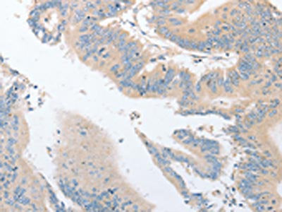 The image on the left is immunohistochemistry of paraffin-embedded Human colon cancer tissue using EPS15L1 Antibody(EPS15L1 Antibody) at dilution 1/30, on the right is treated with fusion protein. (Original magnification: ×200)Rabbit anti-Human EPS15L1 Polyclonal Antibody