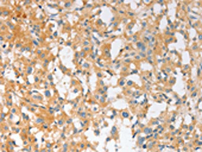 The image on the left is immunohistochemistry of paraffin-embedded Human thyroid cancer tissue using the antibody Antibody) at dilution 1/30, on the right is treated with fusion protein. (Original magnification: ×200)Rabbit anti-Human EPS15L1 Polyclonal Antibody
