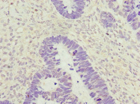 Immunohistochemistry of paraffin-embedded human ovarian cancer using ZWINT Antibody at dilution of 1:100Rabbit anti-Human ZWINT Polyclonal Antibody