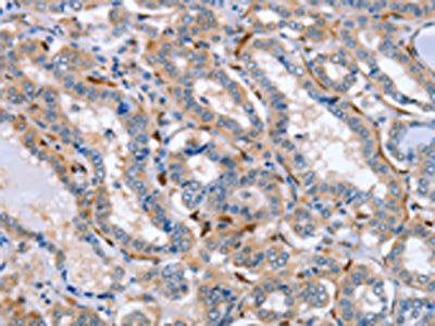 The image on the left is immunohistochemistry of paraffin-embedded Human thyroid cancer tissue using LXN Antibody(LXN Antibody) at dilution 1/25, on the right is treated with fusion protein. (Original magnification: ×200)