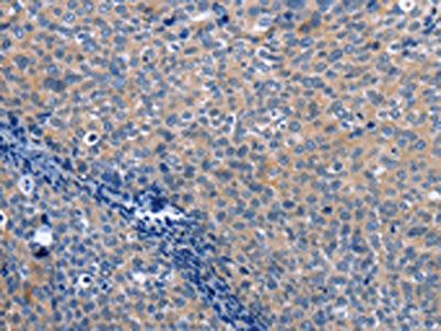 The image on the left is immunohistochemistry of paraffin-embedded Human cervical cancer tissue using the antibody Antibody) at dilution 1/25, on the right is treated with fusion protein. (Original magnification: ×200)