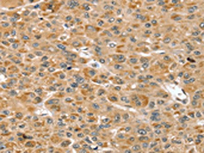 The image on the left is immunohistochemistry of paraffin-embedded Human liver cancer tissue using the antibody Antibody) at dilution 1/30, on the right is treated with fusion protein. (Original magnification: ×200)Rabbit anti-Human RNH1 Polyclonal Antibody