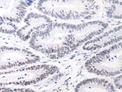The image on the left is immunohistochemistry of paraffin-embedded Human colon cancer tissue using JUND Antibody(JUND Antibody) at dilution 1/40, on the right is treated with synthetic peptide. (Original magnification: ×200)