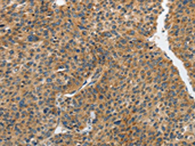 The image on the left is immunohistochemistry of paraffin-embedded Human liver cancer tissue using the antibody Antibody) at dilution 1/25, on the right is treated with synthetic peptide. (Original magnification: ×200)Rabbit anti-Human PIP5K1C Polyclonal Antibody