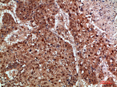 Immunohistochemical analysis of paraffin-embedded human-lung-cancer, antibody was diluted at 1:200Rabbit anti-Human TICAM1 Polyclonal Antibody