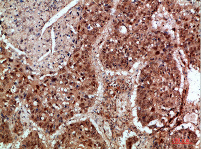 Immunohistochemical analysis of paraffin-embedded human-lung-cancer, antibody was diluted at 1:200Rabbit anti-Human TICAM1 Polyclonal Antibody