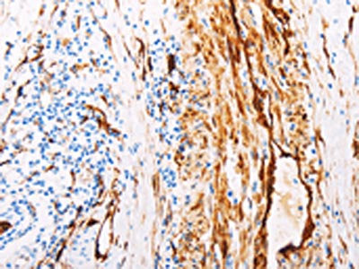The image on the left is immunohistochemistry of paraffin-embedded Human colon cancer tissue using TGM2 Antibody(TGM2 Antibody) at dilution 1/15, on the right is treated with fusion protein. (Original magnification: ×200)Rabbit anti-Human TGM2 Polyclonal Antibody