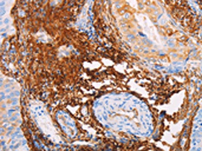 The image on the left is immunohistochemistry of paraffin-embedded Human cervical cancer tissue using the antibody Antibody) at dilution 1/15, on the right is treated with fusion protein. (Original magnification: ×200)Rabbit anti-Human TGM2 Polyclonal Antibody